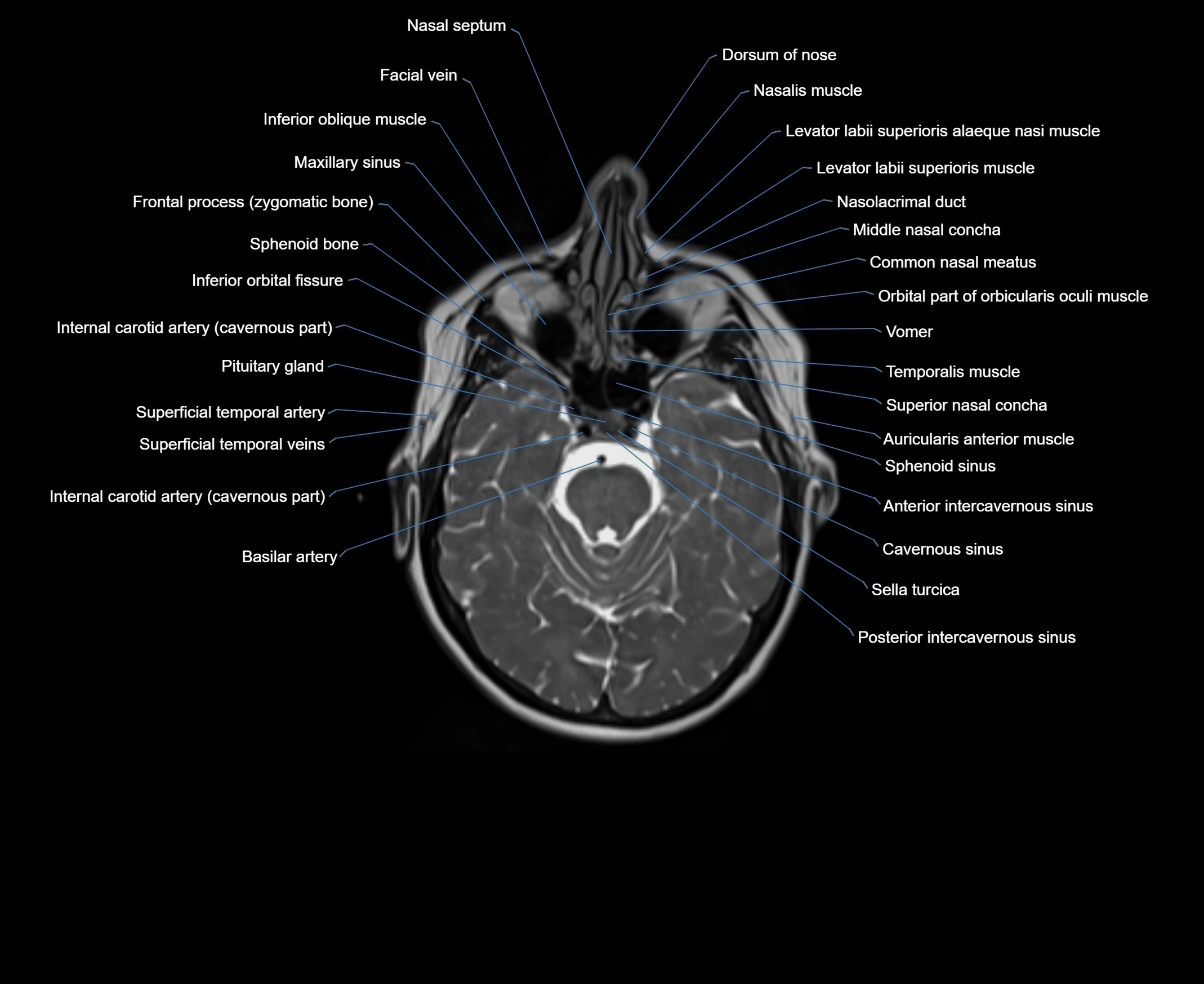 MRI Neck 3D labelled cross section anatomy axial 3t image-00001-00003.webp